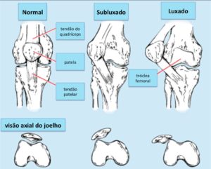Instabilidade-Patelar